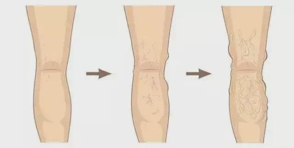 恒利配资 腿上的“小蛇”该怎么对待